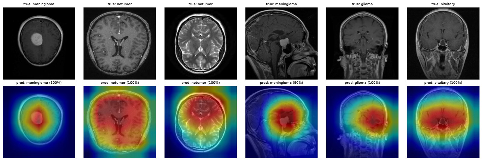 Grad-CAM: the model highlights the tumor region on brain MRIs
